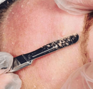 Plain Jane? Not a Chance with Denver Dermaplane Services to Brighten & Tighten Skin plainJaneCornflake 300x287 - Plain Jane? Not a Chance with Denver Dermaplane Services to Brighten & Tighten Skin